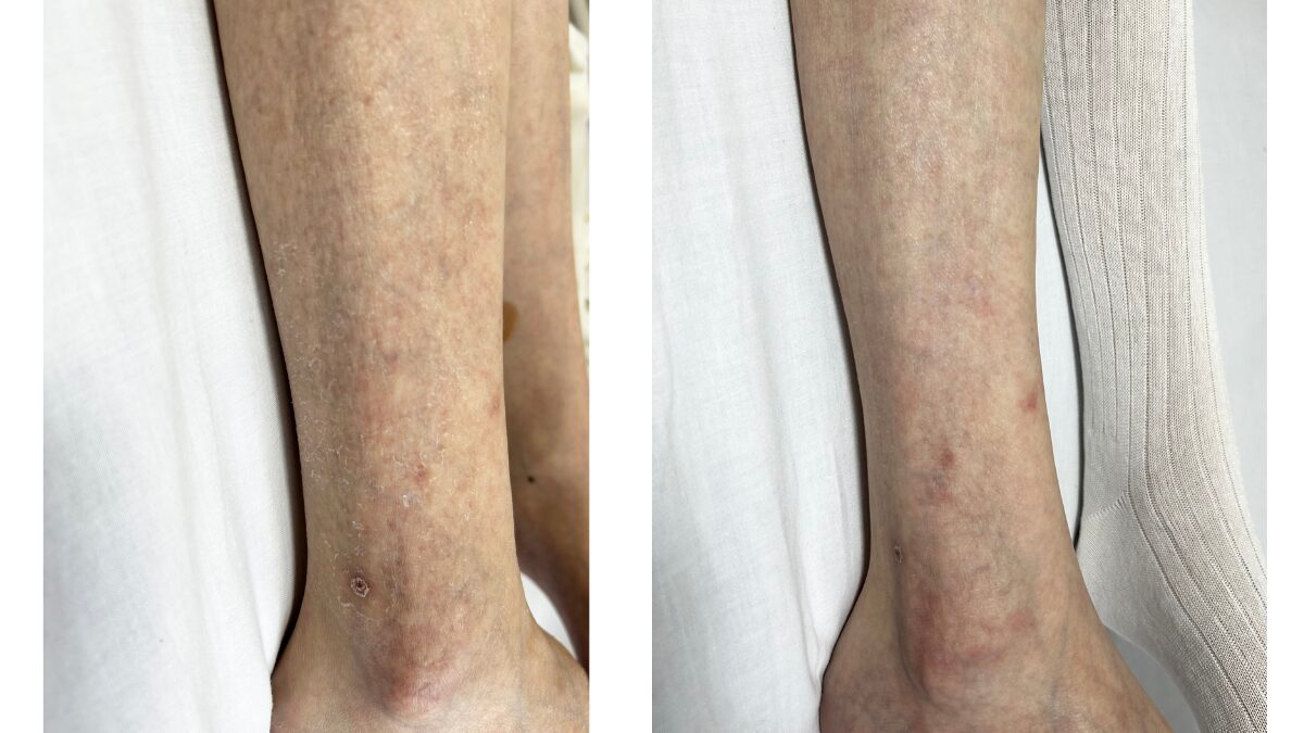 電動ベッド上で撮影した、竹布おやすみソックス着用前後の脚の乾燥状態（膝から足首）