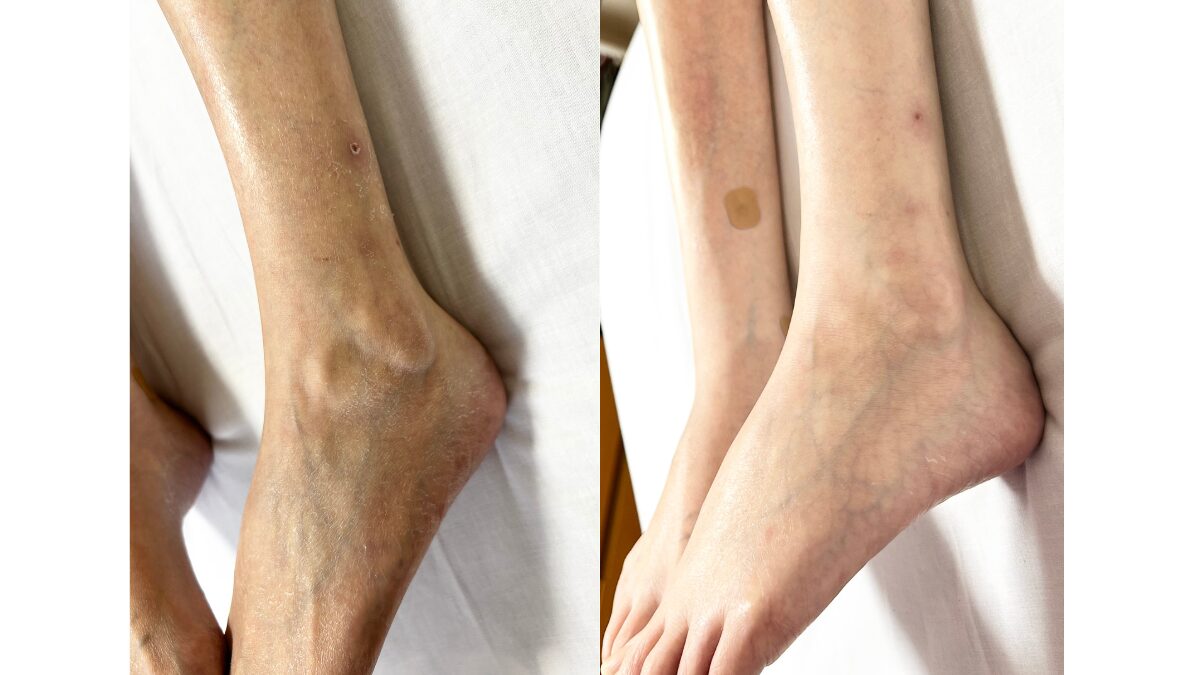 電動ベッド上で撮影した、竹布おやすみソックス着用前後の脚の乾燥状態（左脚の膝から足首）