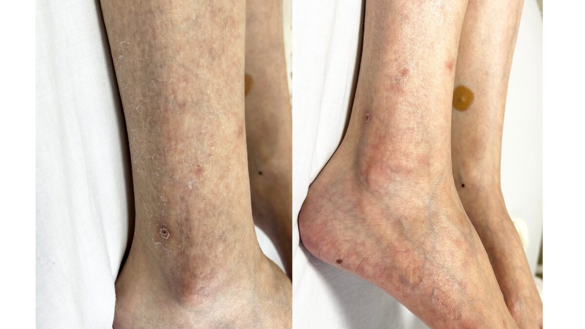 電動ベッド上で撮影した、竹布おやすみソックス着用前後の脚の乾燥状態（右脚の膝から足首）